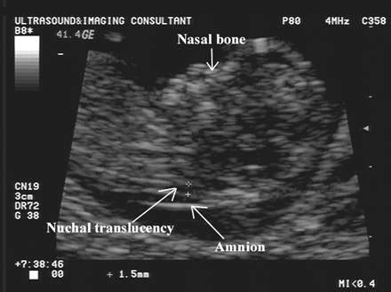 nuchal skinfold thickness measurement|nuchal translucency normal range at 13 weeks.